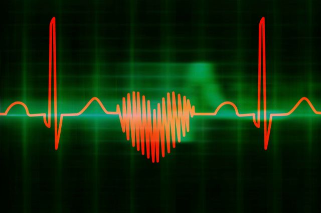 taquicardia corazon electrocardiograma